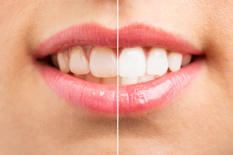 Teeth before and after whitening