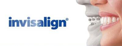 invisalign wireless braces