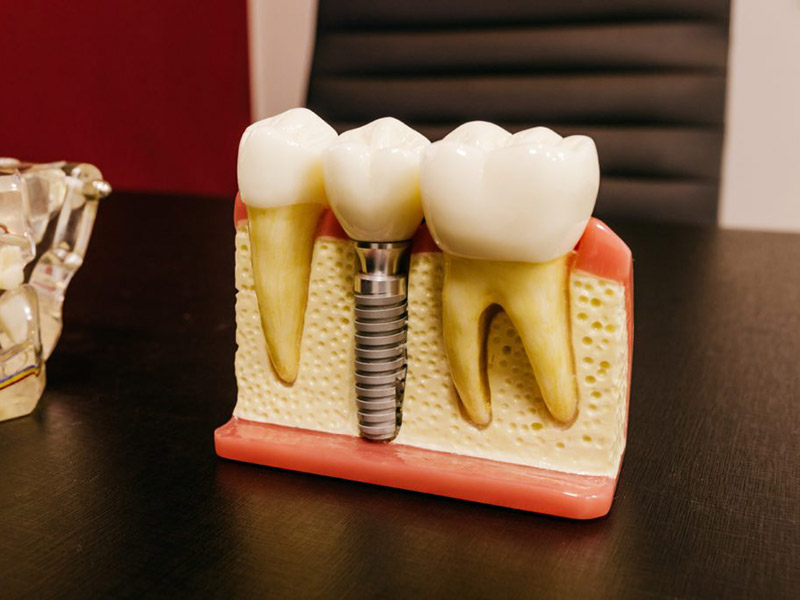 Dental implants.